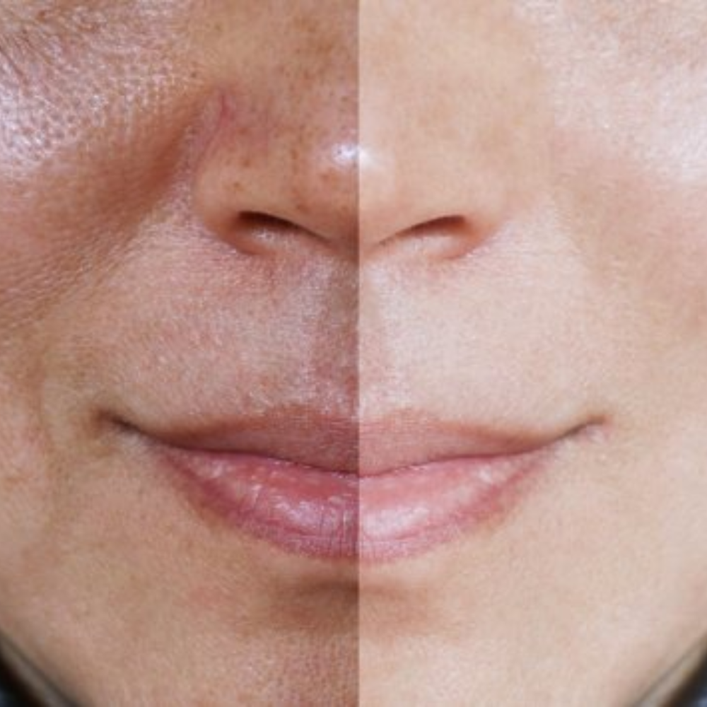 DermaBee Pro™ - Alívio total da dor e rejuvenescimento da pele no mesmo dia
