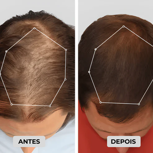 Boné de terapia de luz vermelha para tratamentos de regeneração capilar
