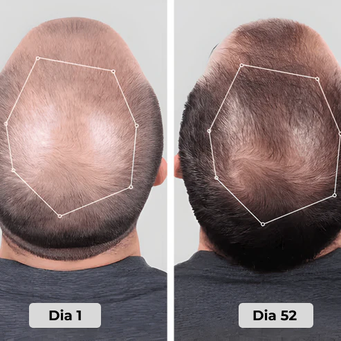 Boné de terapia de luz vermelha para tratamentos de regeneração capilar