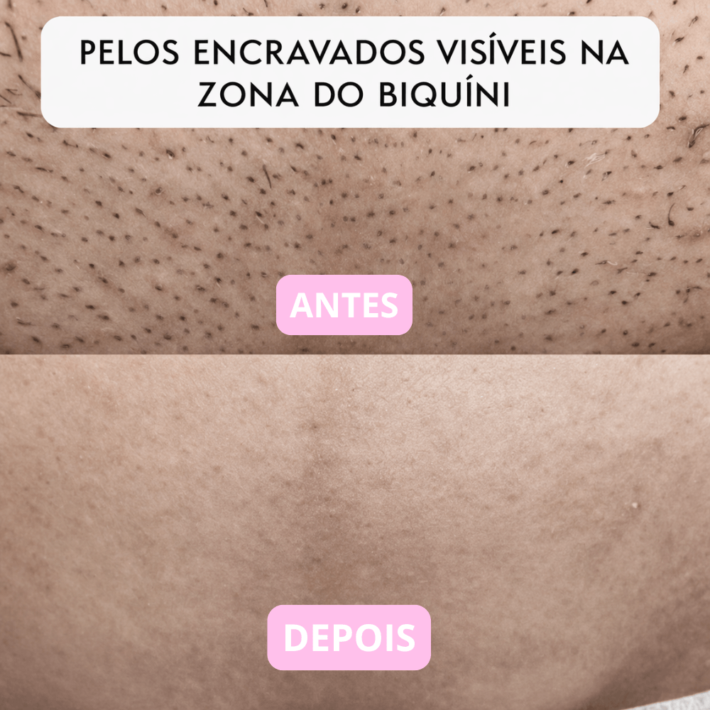 Depiladora Íntima 2 em 1 — Suave & Precisa